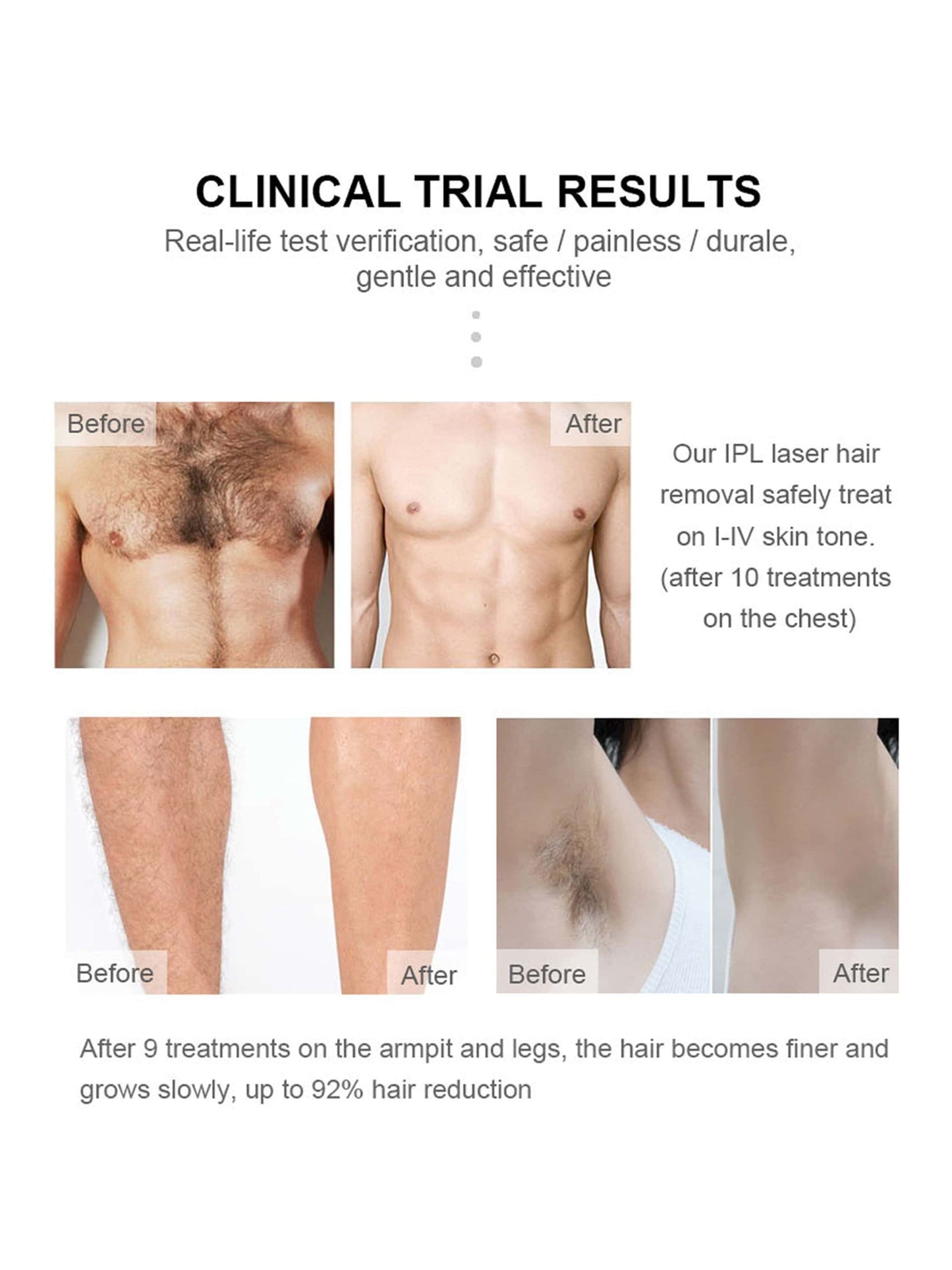 1pc Hair Remover, Upgraded To 1000000 Flashes With Ice Cooling Function, For Men & Women, Painless & Long Lasting Effects On Face, Armpit, Leg And Bikini Area, Comes With Protective Glasses